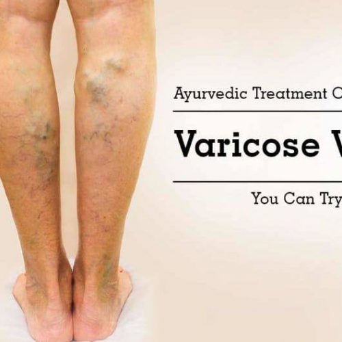 Varicose Veins