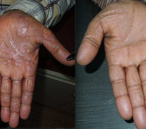 Psoriasis